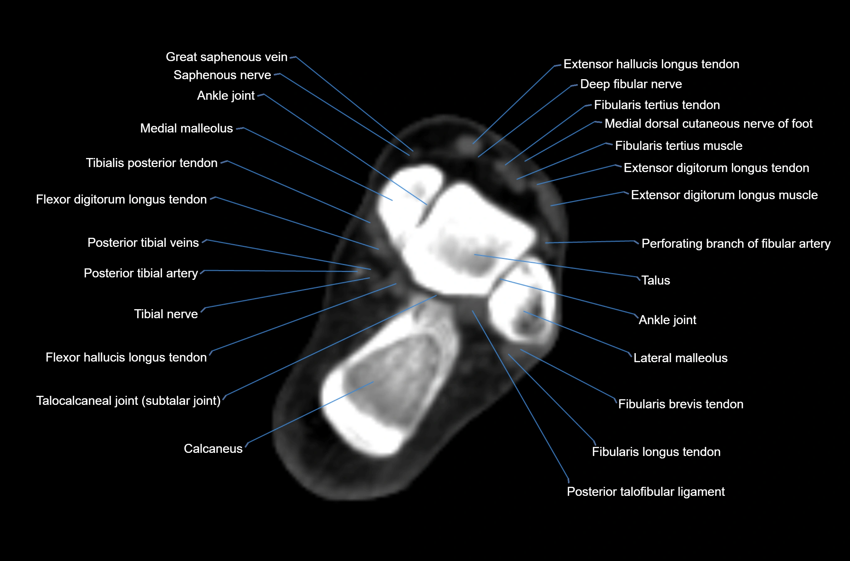 CT Ankle axial cross sectional anatomy labelled image -00031.webp